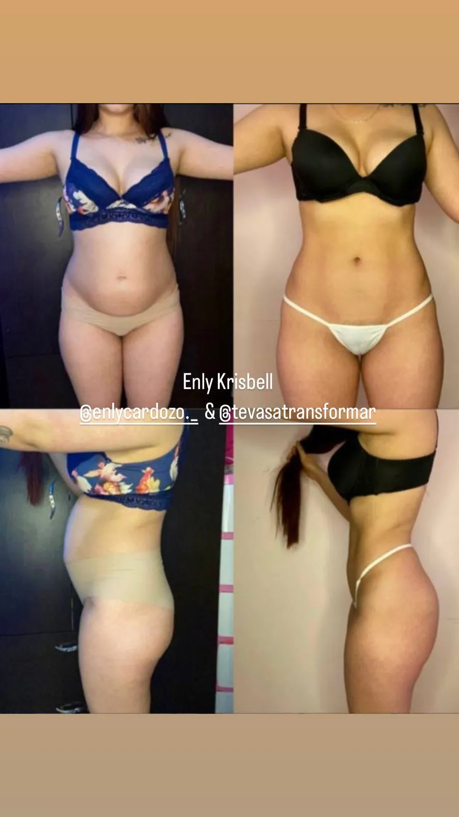 Resultado antes y después de Enly Krisbell con el Método TVT